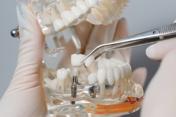 Top   Benefits Of Choosing Dental Implants For Missing Teeth